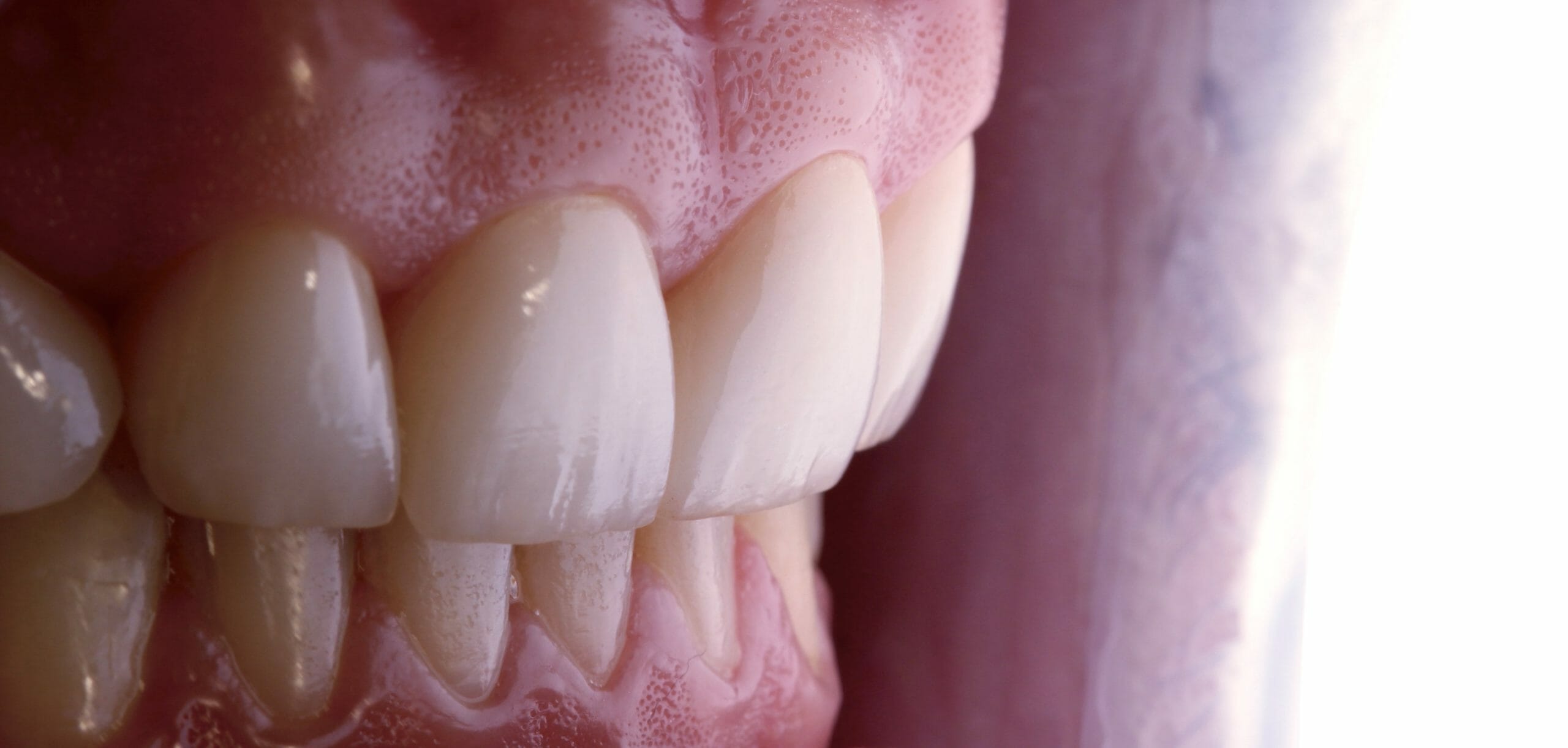 Como Fica Os Dentes Antes De Colocar As Lentes Lentes de Contato - Clinica Kraul